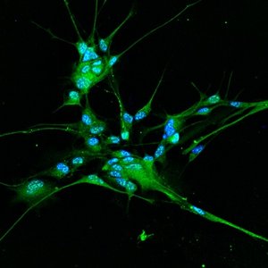 colorazione (in verde) per il canale TMEM16B, un canale cloro attivato da calcio, su cellule di glioma derivate da paziente. I nuclei cellulari sono colorati in blu